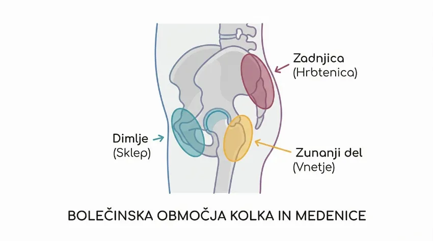 Infografika prikazuje tri lokacije bolečine v kolku: dimlje, zunanji del boka in zadnjica